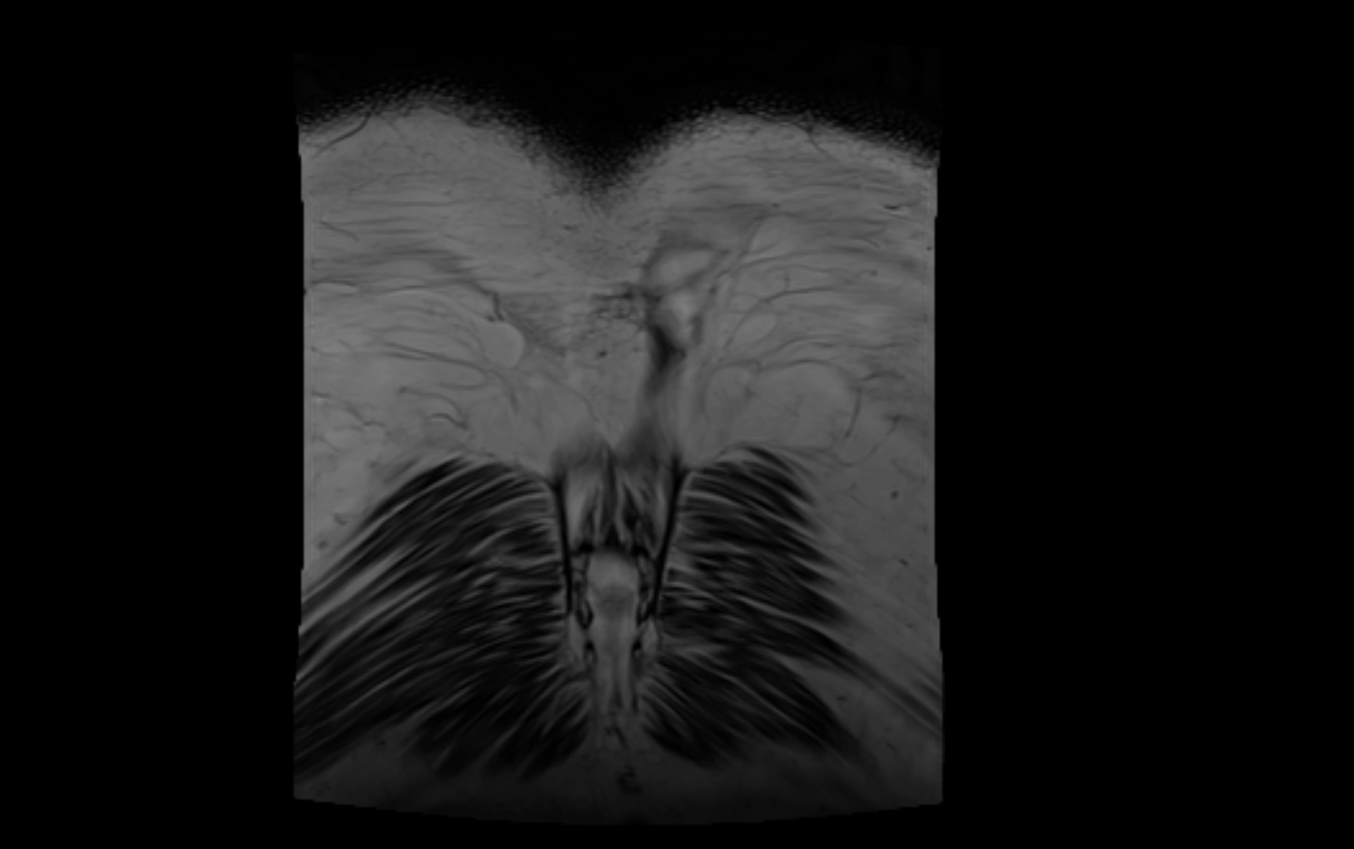 MR lumbosacral plexus cross sectional anatomy 3T  radiology  image-img-09001-00087.webp